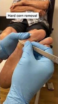 Eliminate Large Hard Corns: Safe and Effective Corn Removal