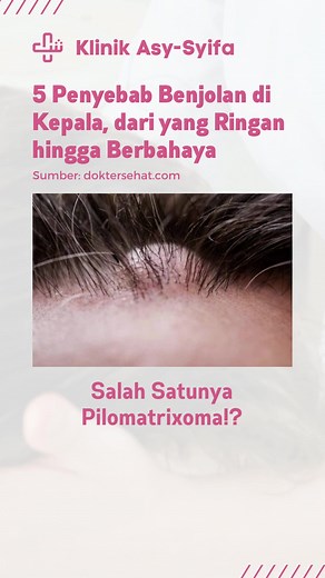 Nah, itulah beberapa penyebab benjolan di kepala, mulai dari kasus ringan hingga berbahaya. Jika benjolan terjadi akibat cedera kepala atau dibarengi dengan gejala-gejala lain, segera periksakan kondisi ke dokter. Baca selengkapnya di: https://doktersehat.com/informasi/kesehatan-umum/benjolan-di-kulit-kepala-tanda-awal-munculnya-kanker-tulang-tengkorak/ Cek Kesehatan Secara Rutin dan Berobat di Praktek Dokter Umum Asy-syifa. 📍Lokasi: Ruko Cimanggu Center Point, Kota Bogor ✆ Informasi & Pendafta