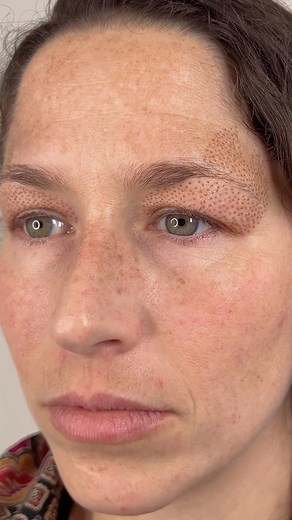 Plasma Lift Upper Eyelid treatment for this client✨ This treatment is not just for older clients with sagging skin, it is an effective option for anyone who has excess/sagging skin or heavy lids. Stay tuned for healed results in about 8-10 weeks✨ Non surgical plasma lift is just one appointment away. Click the “BOOK NOW” button in my bio✨ ✨Treatment time: 1-1.5 hrs ✨Downtime: 5-7 days for the scabs to fall off ✨Healing time: 8-10 wks to see full results ✨How long do the results last? 3-4 years |