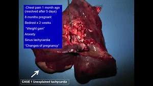 PE - The Great Masquerader: A Disease of Many Faces: Cases Where I Was Fooled