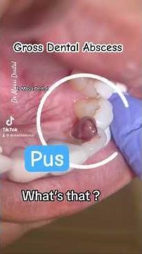 Periapical Abscess and Endodontic treatment pus drainage