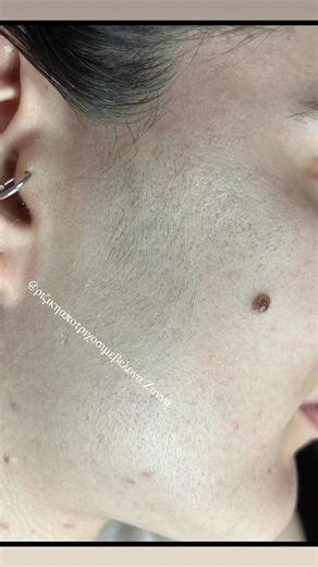 ☺️Έχουμε πολύ καλά αποτελέσματα. Το πρόσωπο ήταν πιο λευκό, πιο λείο και πιο φωτεινό💁🏻‍♀️ | Ριζικη αποτριχωση με βελονα