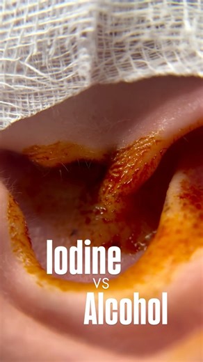 Piercer Sol on Instagram: "When it comes to surgical skin prep for piercings, Alcohol & Iodine get lumped together a lot, but they work in completely different ways. Alcohol, whether it’s isopropyl or ethanol, works fast. It kills bacteria by breaking down their cell membranes & denaturing proteins (disinfection) and it can handle a decent range of microbes. But as soon as it evaporates, it’s done working! It doesn’t leave behind any residual protection, & doesn’t reach into hair follicles or se