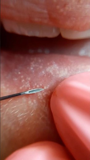 Getting Rid of Fordyce Spots on lips