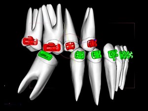 Uprighting molars with the Straight wire system part 1