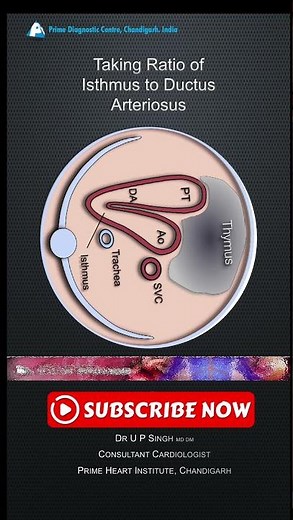 Ratio of the isthmus to the ductus arteriosus on fetal echocardiography #isthmus