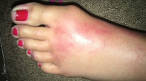 Flesh-eating bacteria ravages woman's foot, exposing bone