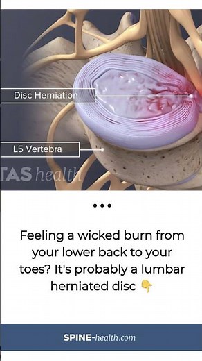 Lumbar Disc Function & Herniation | What Causes a Herniated Disc?