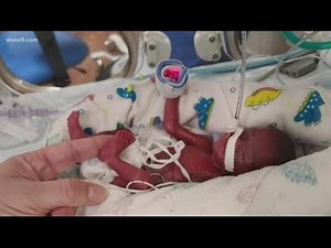 Holy Cross Health treats smallest micro baby at NICU on record
