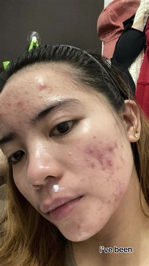 This is the worst acne break out I had in my entire life. This acne journey started last February when heart break and midlife crisis happened. I lost the drive in taking care of myself and I lost my focus in everything. It was not easy especially that people started to noticed the changes. I lost my self confidence, I felt unmotivated, I was so conscious and I was stuck in a feeling of a never ending cycle and felt like I can’t go back to how I looked before. When I noticed this break out was g