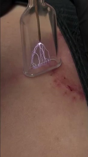 Fusion 8 Cold Atmospheric Plasma Treatment