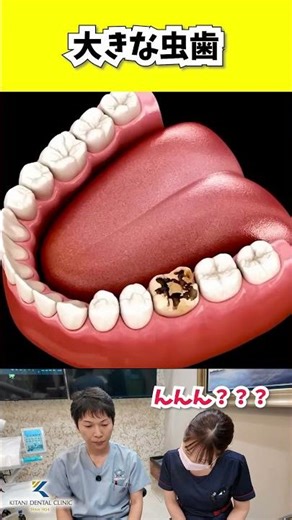 大きな虫歯があったらどうする？木谷歯科医院が解説します！ #大きな虫歯 #shorts