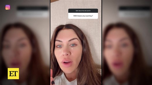 'The Secret Lives of Mormon Wives' star Jessi Ngatikaura gives fans an inside look at her latest plastic surgery procedure: an under-eye skin pinch. | Entertainment Tonight