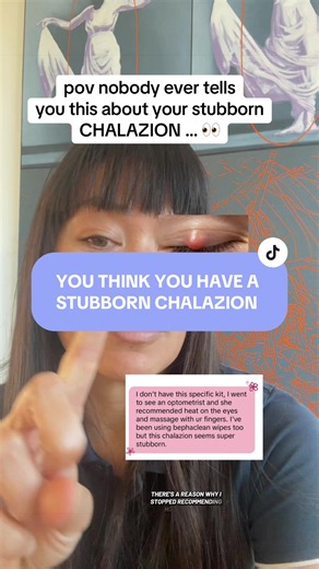 Stubborn Chalazion? How to Treat at the Lid Margin Safely