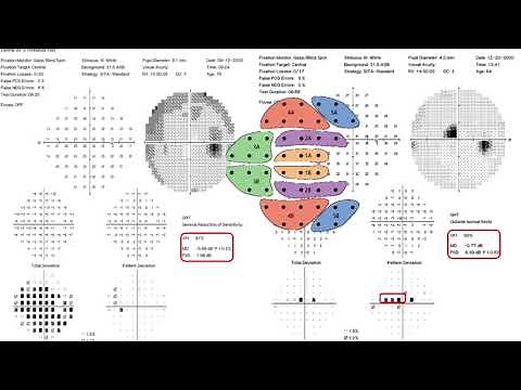 7- Visual filed interpretation( Glaucoma Hemifield test, GHT, and visual filed index, VFI).