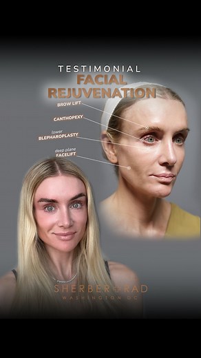 Restoring youthfulness naturally and with longevity means studying every nuance of a patient’s anatomy. Ashley’s case required especially thoughtful planning for 3️⃣ key reasons: 1. Strong bone structure, limited soft tissue volume 💀 Her skeletal architecture is beautifully defined — a tremendous advantage for long-term support. But her extremely slender frame meant a global paucity of facial volume, which made her features appear sharper and reduced the predictability of fat graft take. Parado