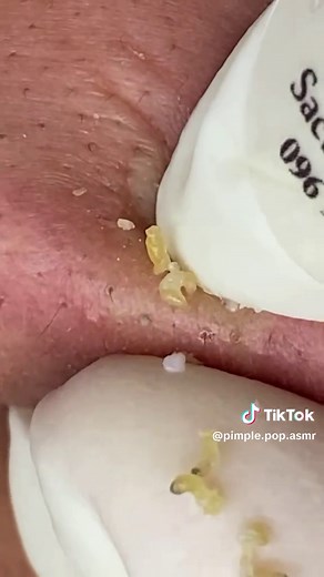 Relaxing Pimple Pops for Clear Skin