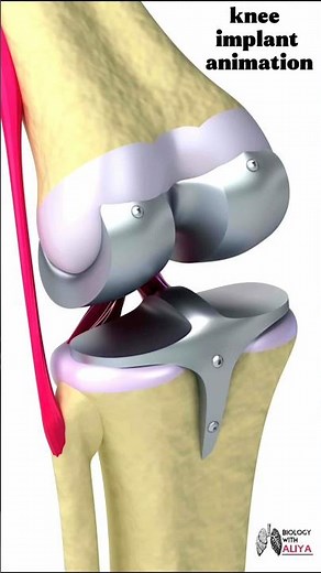 knee implant animation #medical #animation #3d #short | Biology with Aliya