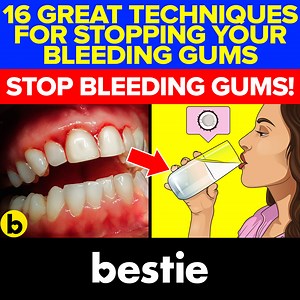 2.6K views · 83 reactions | 16 Great Techniques for Stopping Your Bleeding Gums Sources: https://pastebin.com/9yCw3H1D #BleedingGums #HowToStopBleedingGums #Bestie | Bestie | Facebook