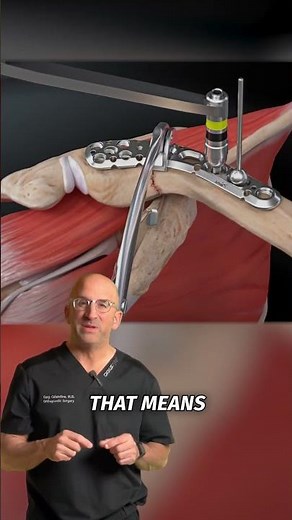 Collare Bone Plate and Screws #shorts