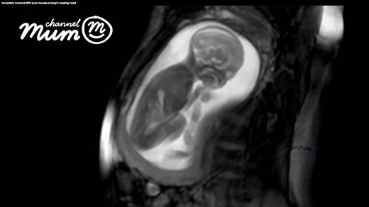 1.2M views · 20K reactions | AMAZING: This MRI scan of a baby at 20 weeks shows the preborn child moving around in the womb, turning her head, and kicking — even revealing the child's beating heart. Video courtesy of Channel Mum. For more information, visit: ChannelMum.com and iFindProject.com | Live Action | Facebook