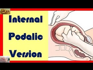Internal podalic version lecture