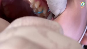 𝗕𝗿𝗮𝗰𝗲𝘀 𝗜𝗻𝘀𝘁𝗮𝗹𝗹𝗮𝘁𝗶𝗼𝗻 𝙃𝙤𝙬 𝙙𝙤 𝙩𝙝𝙚𝙮 𝙥𝙪𝙩 𝙤𝙣 𝗕𝗿𝗮𝗰𝗲𝘀 𝘀𝘁𝗲𝗽 𝗯𝘆 𝘀𝘁𝗲𝗽 𝗣𝗿𝗼𝗰𝗲𝗱𝘂𝗿𝗲🦷🧑‍⚕️ #dr_of_smile #i_love_dentistry❤ #foryou #foryoupage #viral #video #dentist #tiktokpakistan #grow #account #viraltiktok #viralvideo #tiktok #trending