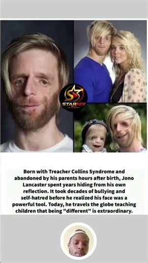 Abandoned at Birth with Treacher Collins Syndrome – Jono Lancaster’s Inspiring Journey ❤️ #shorts