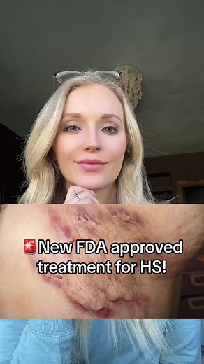 Exciting New FDA Approved Treatment for Hidradenitis Suppurativa