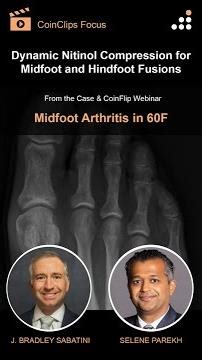 Dynamic Nitinol Compression for Midfoot and Hindfoot Fusions