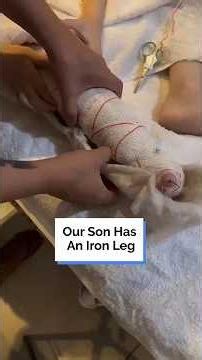 The "Iron Leg" saving his life 🦾🏗️ #MedicalMarvel #IronLeg #RareCondition