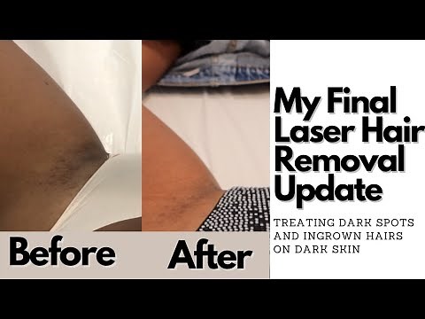Laser Hair Removal Results On Dark Skin | Dark Spots on Bikini Line| Kamrin White
