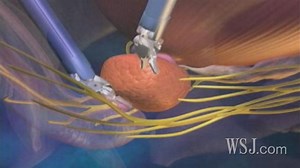 Treating Prostate Cancer with daVinci Robot System