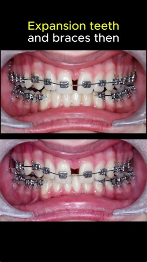 Expansion teeth combine braces to fix deepbite #braces #dentist #orthodontist