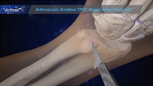 Arthroscopic Knotless TFCC Repair