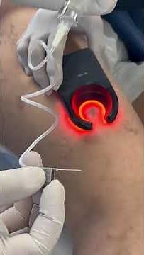 Dr. Alejandro Cabrera Veinlite Demonstration