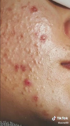 Satisfying With Loan Nguyen Spa Video #acnetreatment
