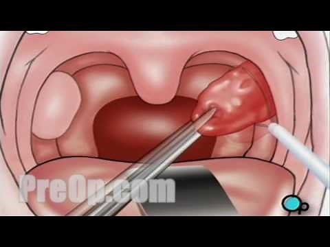 Tonsillectomy in children - Patient Education & Patient Engagement -PreOp®