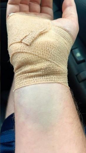 Bruising After Guyon Canal Surgery Release