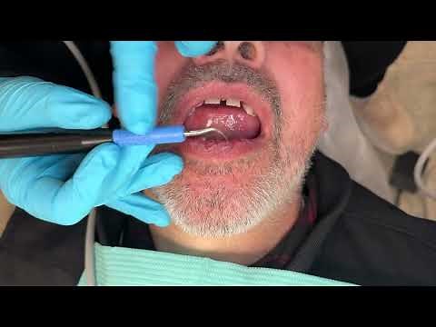 Using the Powerline 1000 Cavitron by Dentsply Sirona