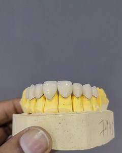 Beautiful perfect 8 on die model. . Checkup at the clinic is free and appointment is must. . "Dr. Ali Rashid's Dental Clinic" Karachi: RJ Mall, 3rd Floor, Gulshan Iqbal Block 10-A, near millennium mall. Timing: Everyday 12-6 (Friday Sunday off) Lahore: 48-A Commercial, Eden city, DHA phase 8, Opposite new airport. Timing: 12-6, 1 week every month. Contact 1 hour before visiting: 03362048058 | Dr. Ali Rashid | Facebook