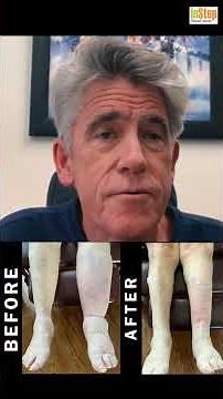 Lymphedema Treatment: Ian Soles explains Intermittent Pneumatic Compression Device| InStep Edmonton