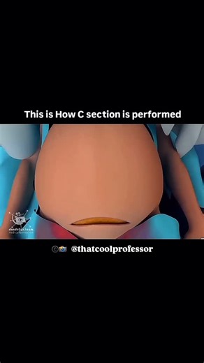 Abhay Mishra | Academic Advisor on Instagram: "Follow🎖️Cesarean Section (C-Section): Procedure, Steps, and Key Information A cesarean section (C-section) is a surgical procedure used to deliver a baby through incisions in the mother’s abdomen and uterus. It is typically performed when a vaginal delivery poses risks to the mother or baby. When is a C-Section Needed? Common reasons for a C-section include: Abnormal fetal position (e.g., breech or transverse lie) Fetal distress (baby not getting e
