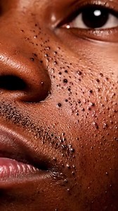 4.4K views · 29 reactions | Unbelievable! Deep Cyst Pimple Explodes Instantly! | Pimple Popping | Facebook