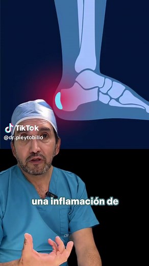 Bursitis en el talón: síntomas y tratamientos