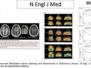 N Engl J Med—AD研究重磅：聚焦超声联合抗Aβ单抗输注对Aβ的清除效果更佳，只是Aducanumab的曲线有点怪！