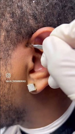 Ear preauricular pit cleaning #asmr #piercing #blackheadsinear #duet #earinfection