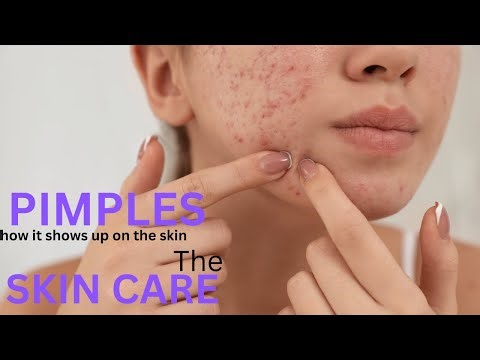 How pimples shows up, treatment and skin care
