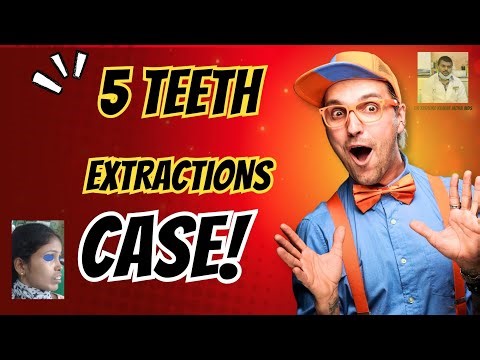 Braces for bimaxillary protrusion with lower crowding treated with 5 teeth removal