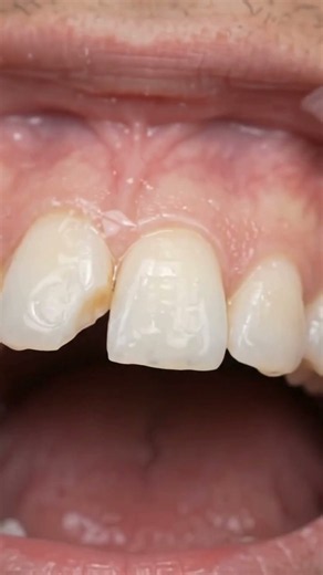 Fixing a Chipped Front Tooth with Composite Bonding 🦷
